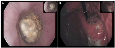 Esophageal Rhabdoid-Like Tumor: A Rare Disease With Aggressive Clinical Behavior